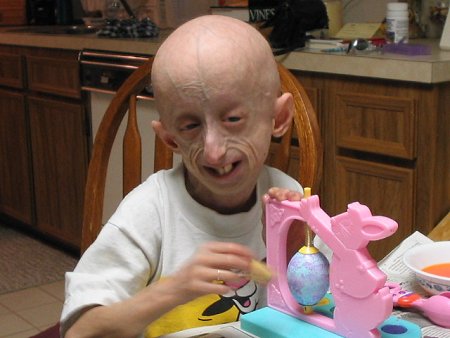 who they diagnosed with progeria. Progeria Frequency: Around 100 documented 