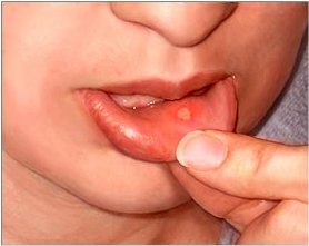 Mouth sores: MedlinePlus Medical Encyclopedia