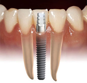 implant, teeth